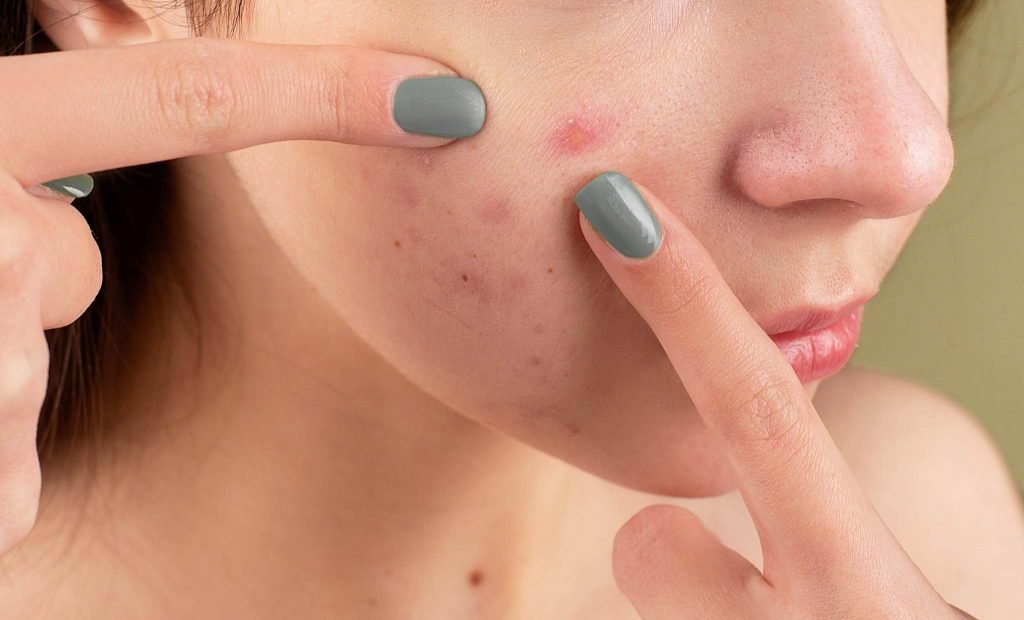 What Foods Cause Acne