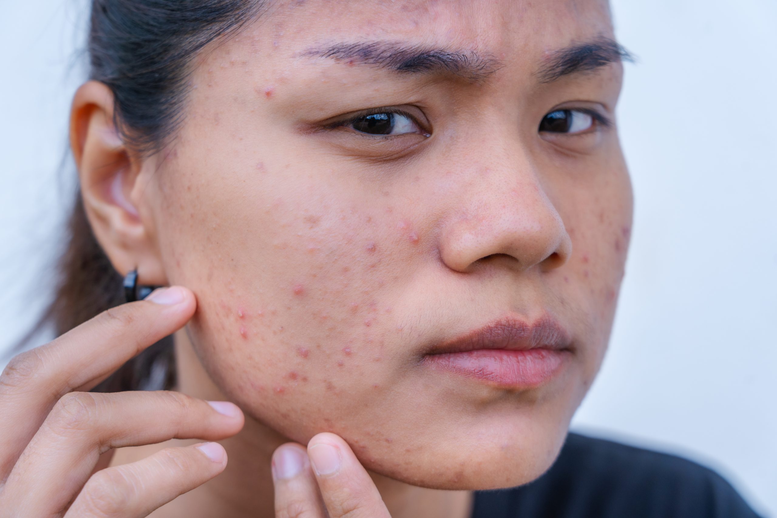Lymecycline For Acne: Your Guide To Clearer Skin