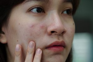 How To Treat Cystic Acne