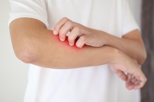 eczema statistics