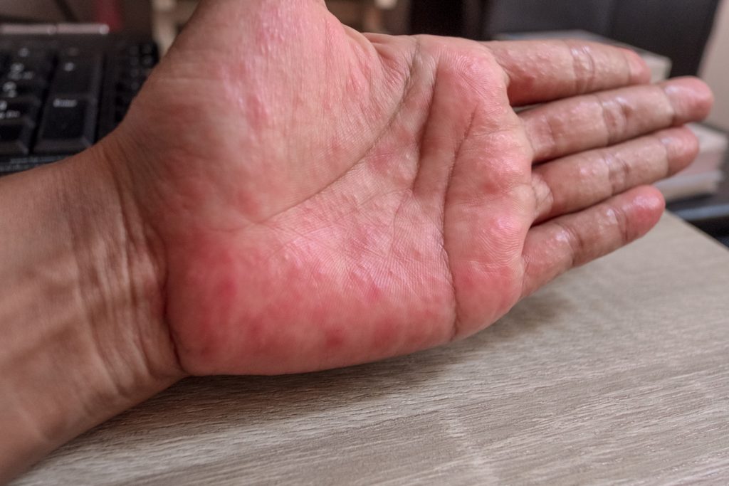 what causes contact dermatitis