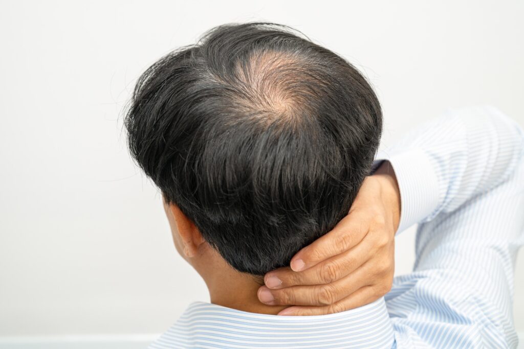 hair loss statistics uk 2024