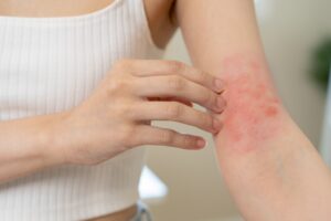 how to get rid of eczema