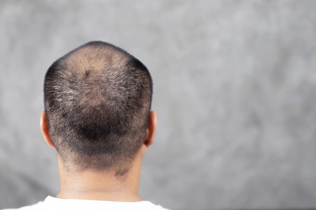 A man with thinning hair looking away from the camera. He is wondering how effective finasteride is for hair loss.