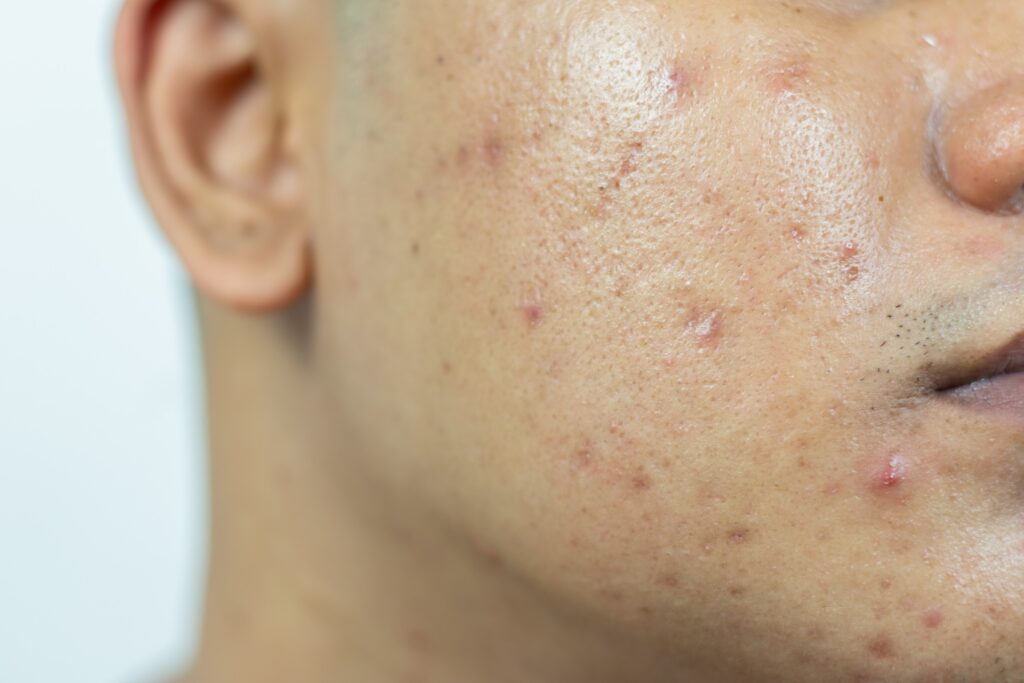 A man with acne, contemplating whether he should choose differin vs tretinoin for acne treatment