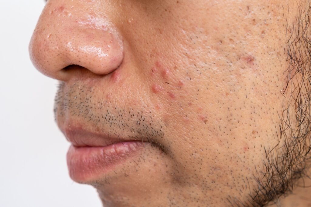 a main with acne who is considering duac gel reviews from real users before deciding whether to use the acne medication