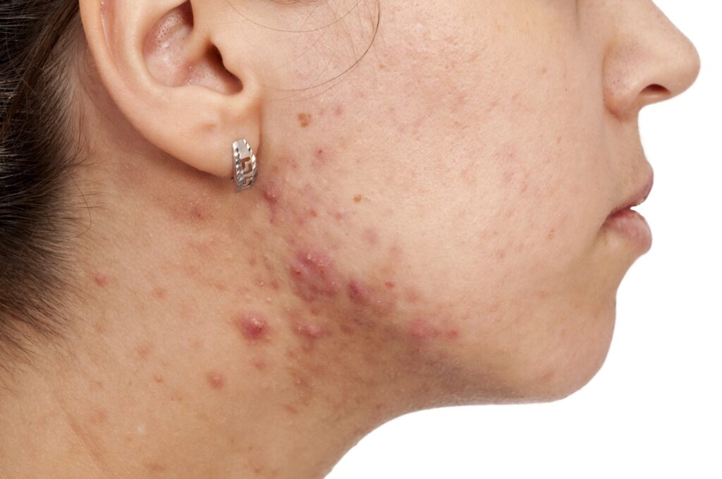 A woman with acne on her face and neck, contemplating the differences between Epiduo vs Duac gel