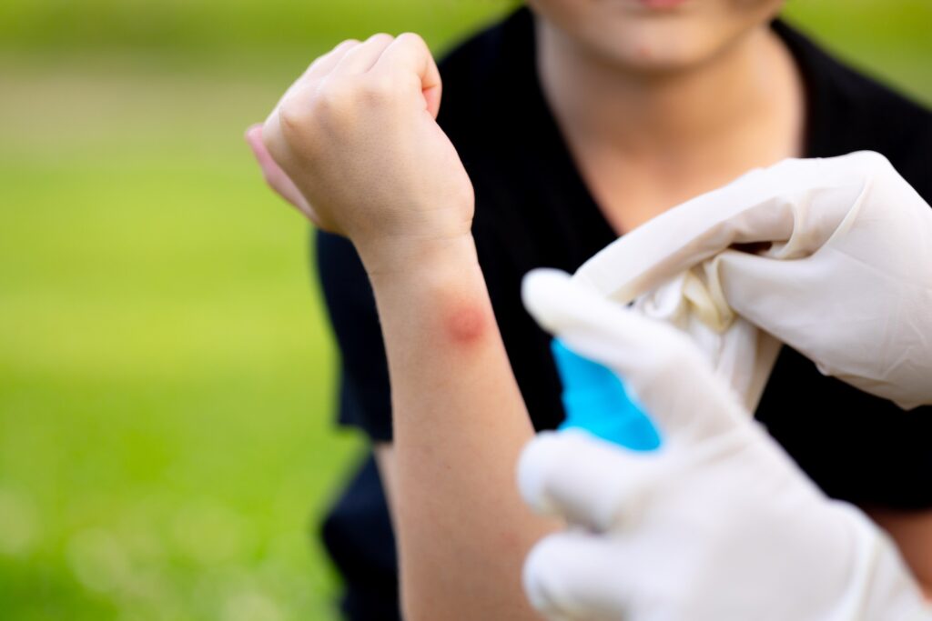 A person with an infected insect bite having treatment applied to represent ‘How to Tell if an Insect Bite is Infected’.