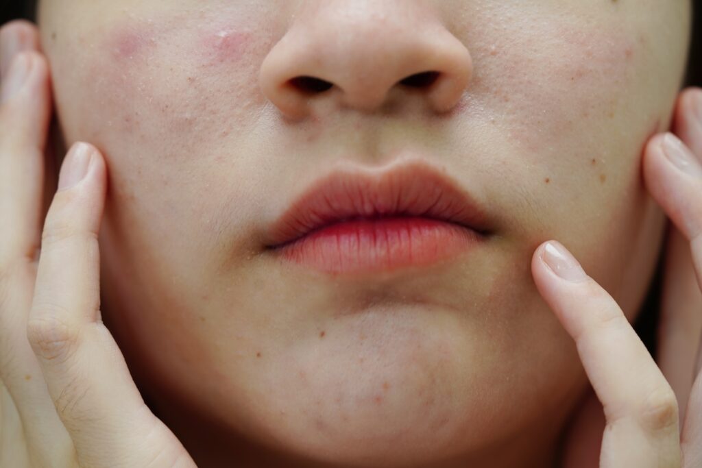 A woman debating whether she is suffering from Acne Rosacea vs Acne Vulgaris