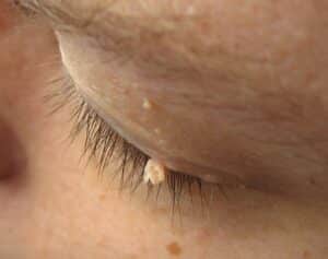 An eyelife with a filiform wart on it