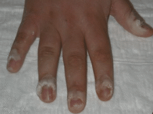 A hand with periungual warts