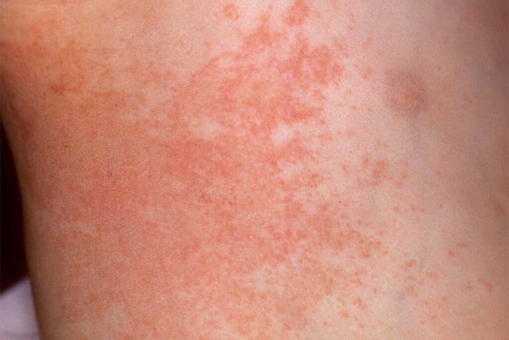 Heat Rash Vs Sun Poisoning Heat Rash On Skin