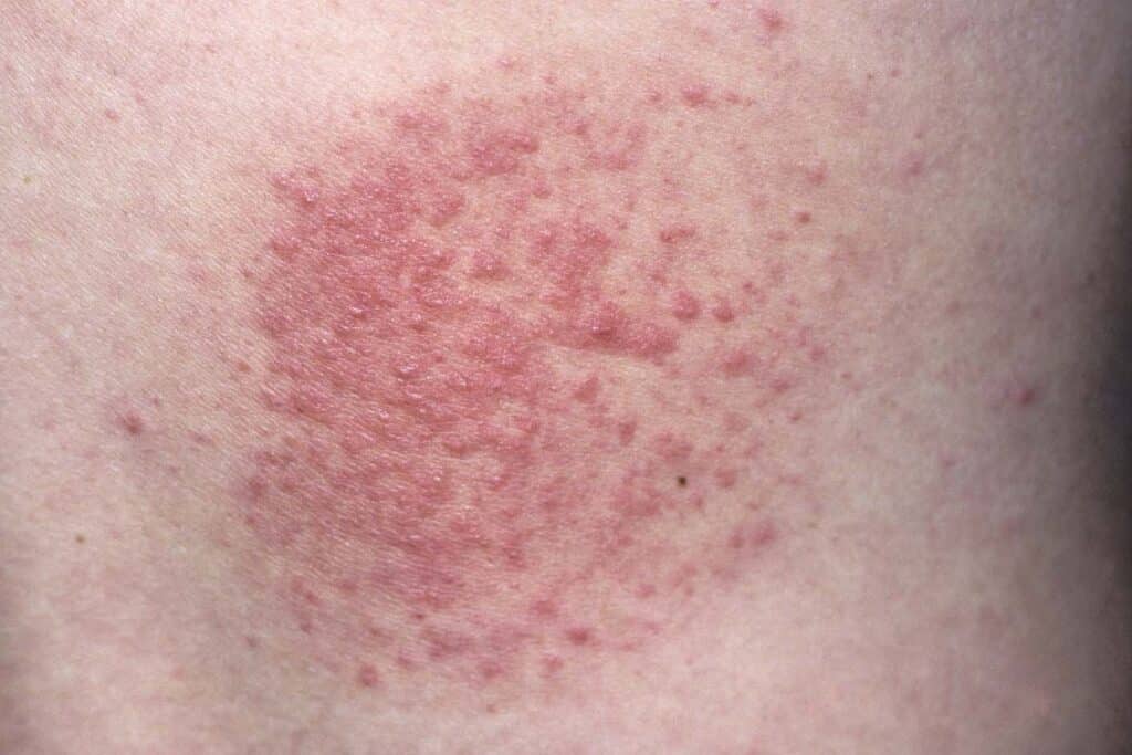 Heat Rash Vs Sun Poisoning Sun Poisoning On Skin